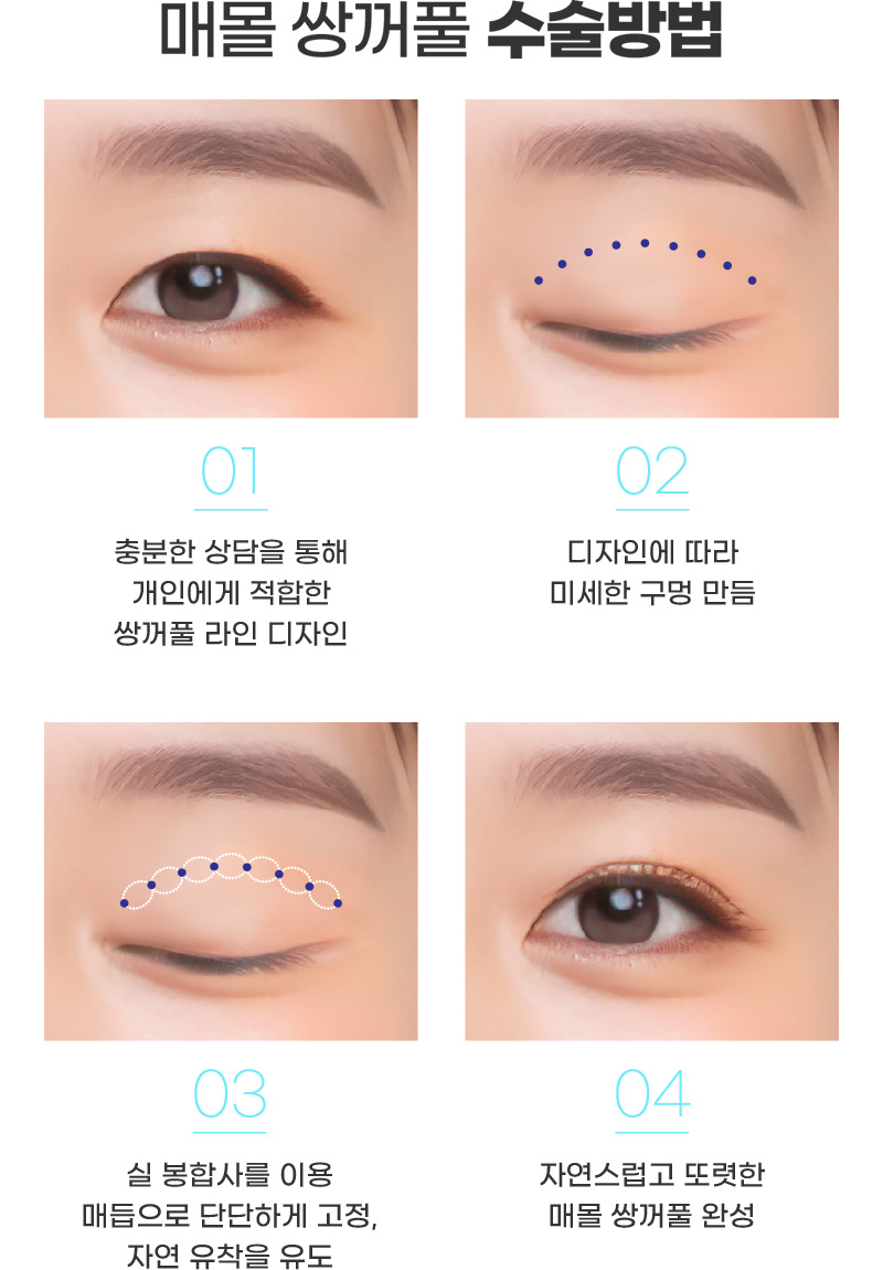 매몰 쌍꺼풀 수술방법