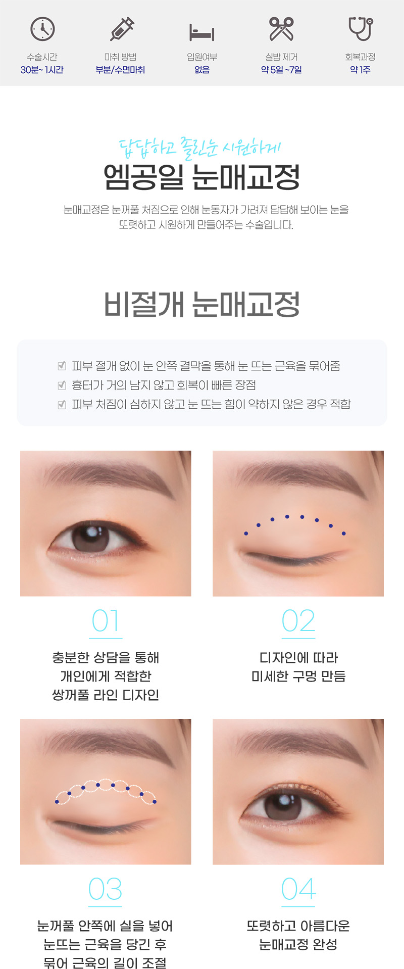 답답하고 졸린눈 시원하게 엠공일 비절개 눈매교정