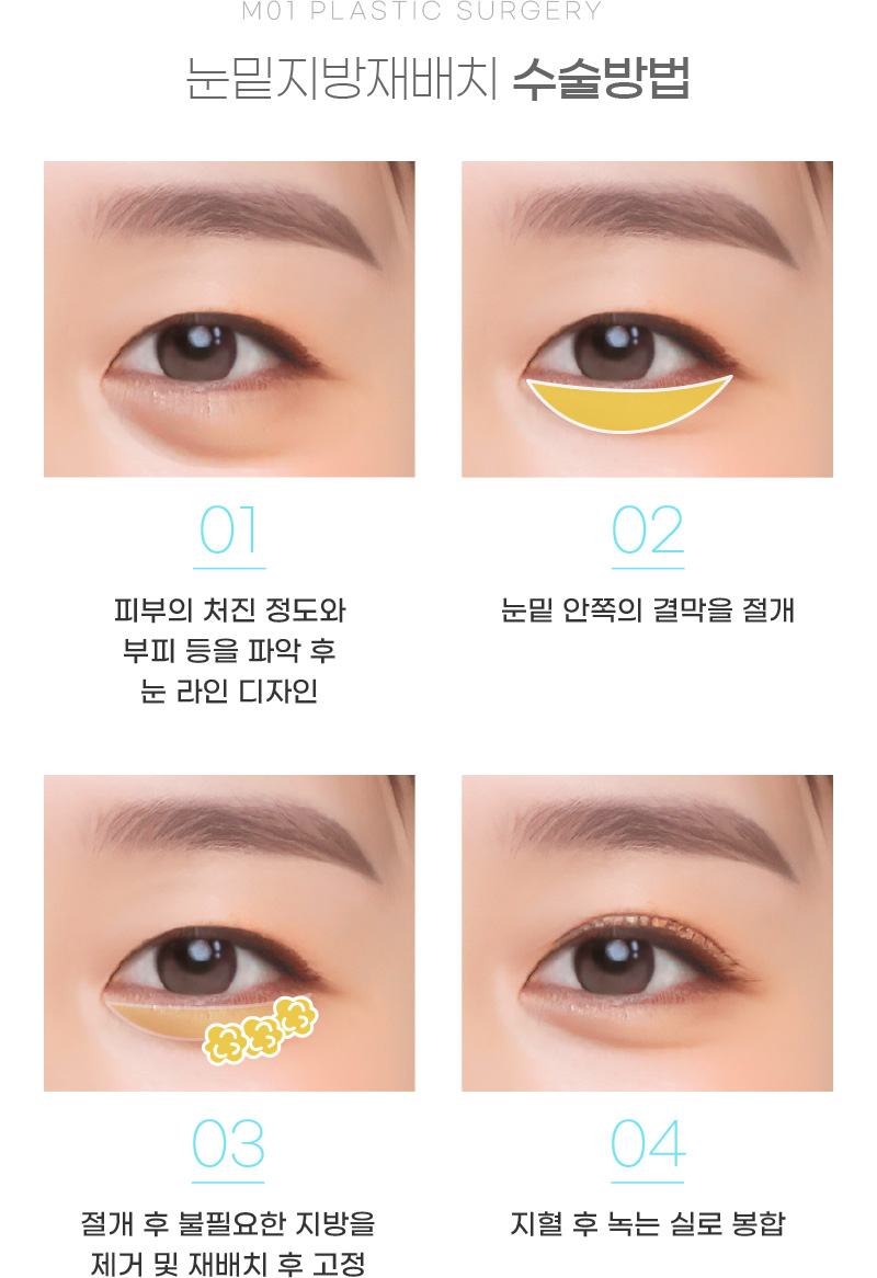 눈밑지방재배치 수술방법