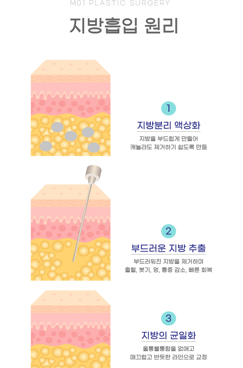 지방흡입 원리