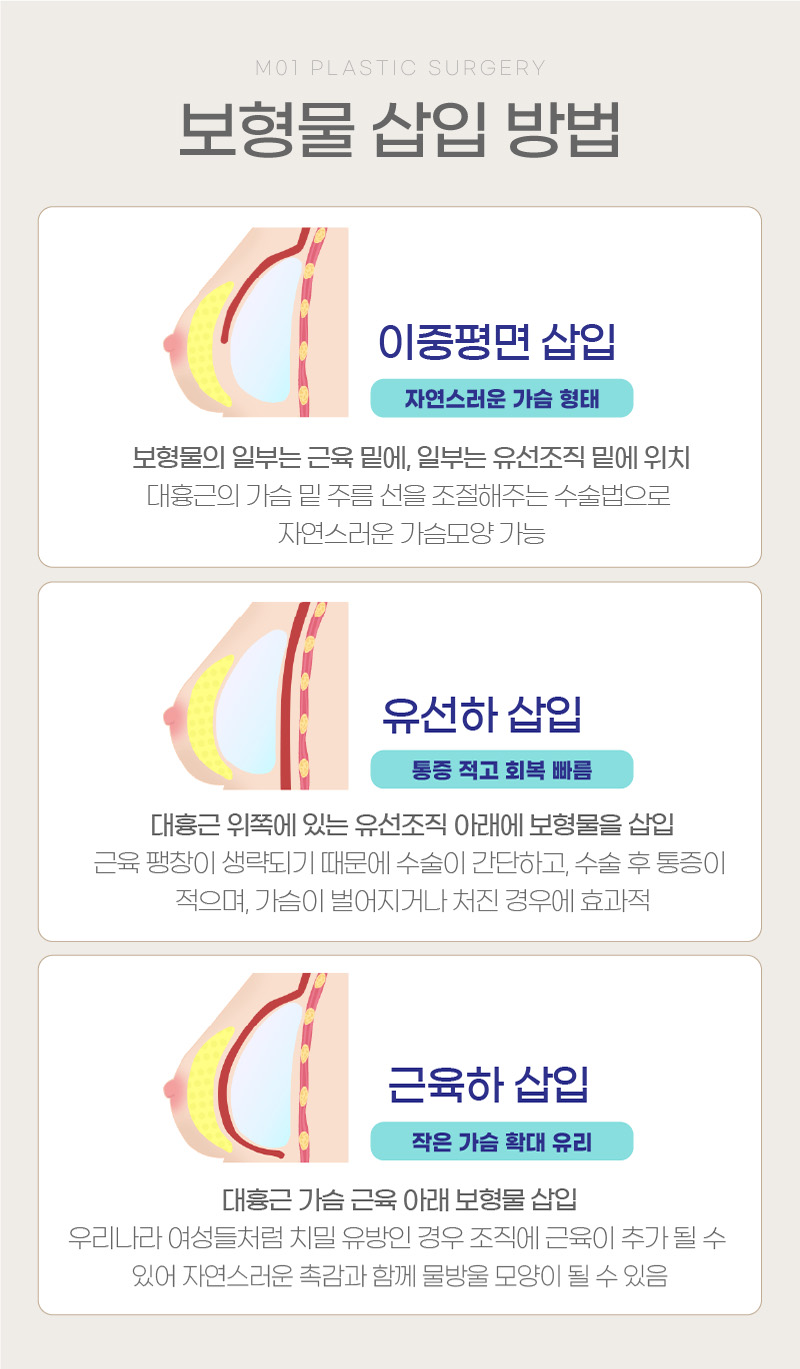 보형물 삽입방법
