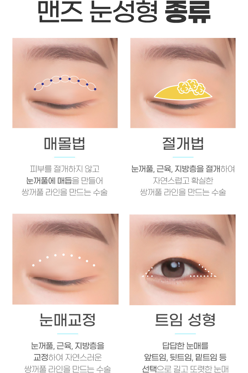 맨즈 눈성형 종류