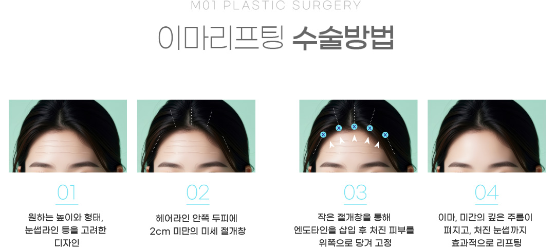 이마리프팅 수술방법