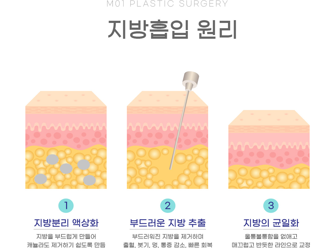 지방흡입 원리